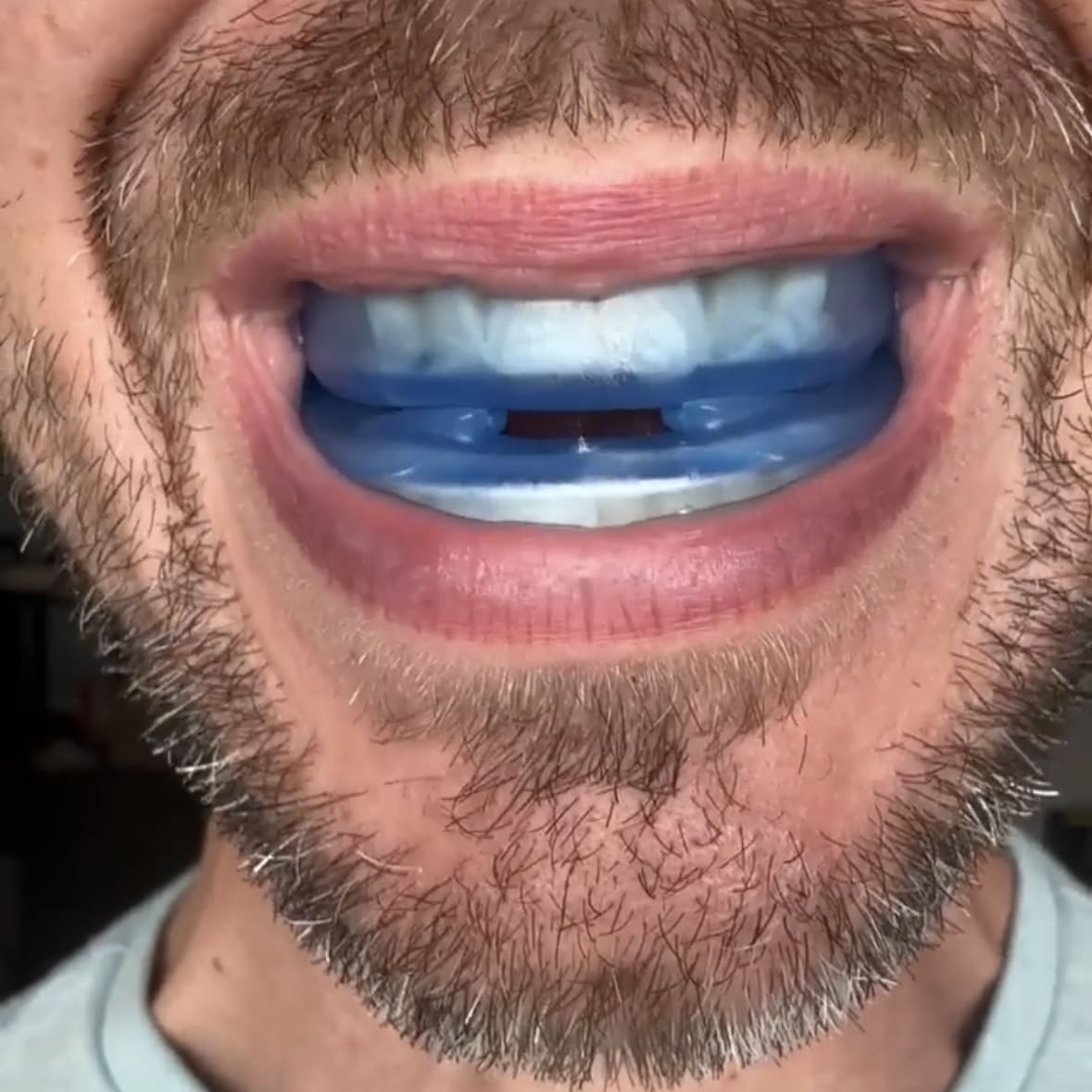 The Quiet Anti-Snoring Mouthpiece (Universal Size)